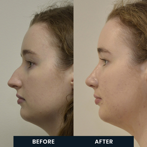 forbandelse bent vores Rhinoplasty Surgery: What to do immediately after your rhinoplasty - Art of  Rhinoplasty